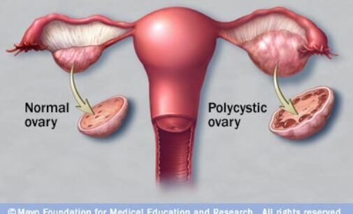 Yet to conceive? It could be a case of PCOS