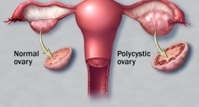 Yet to conceive? It could be a case of PCOS