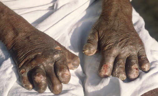 Nigeria ‘records 3,000 new leprosy cases yearly’