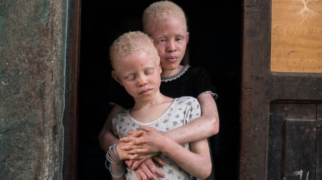 Ban ki-Moon: Merely a myth… Albinos have no magical powers