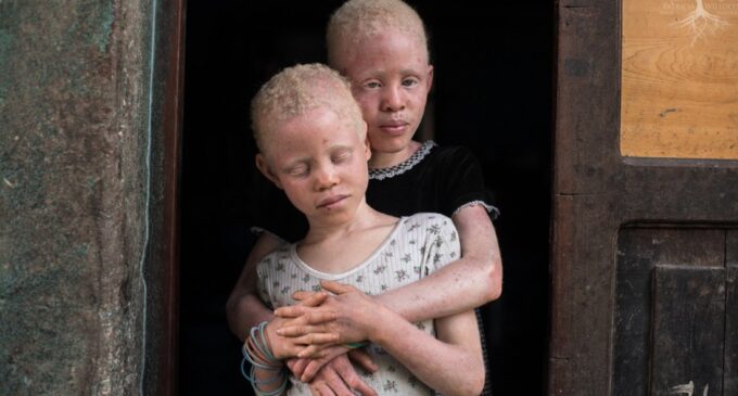 Ban ki-Moon: Merely a myth… Albinos have no magical powers