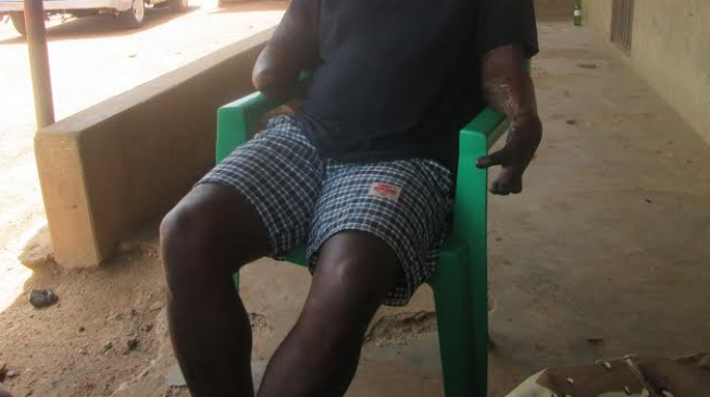 FORGOTTEN SOLDIERS II: The bombed soldier who is now a ‘vampire’… and others at the mercy of the army’s ‘blood-stained corruption’