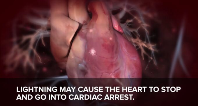 ALERT: Lightning can give you a cardiac arrest