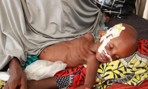 Malnutrition killing Katsina children over councils’ ‘refusal’ to release funds
