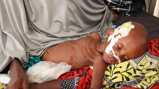 Malnutrition killing Katsina children over councils’ ‘refusal’ to release funds