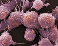 Study: Men with fertility issues more likely to develop prostate cancer
