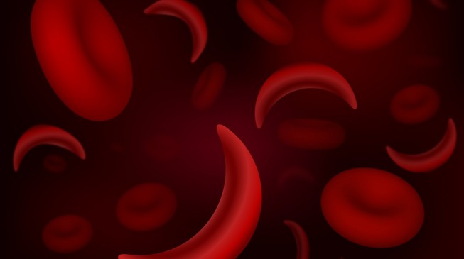 Research: Genetic mutation created sickle cell anemia