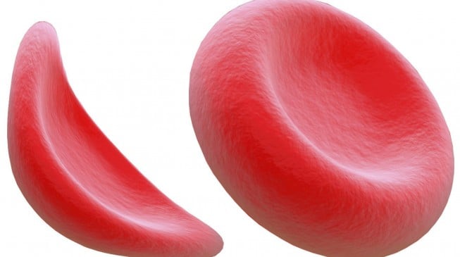 ‘Nigeria has highest rate of sickle cell anaemia in the world BUT no money for cure’