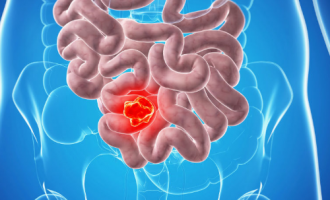 Prolonged use of antibiotics could lead to bowel cancer, study finds