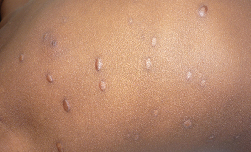 Understanding chickenpox