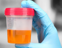 Urine bacteria linked to aggressive prostate cancer identified