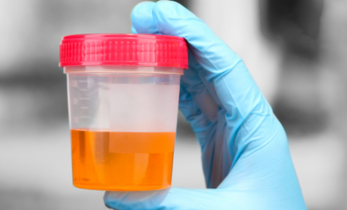 UNILAG: Urine test for malaria has been validated