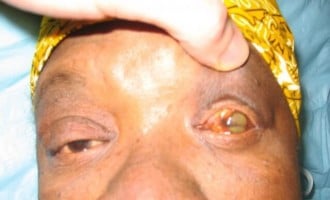 ‘Kogi will be free of yellow fever in the next 40 years’