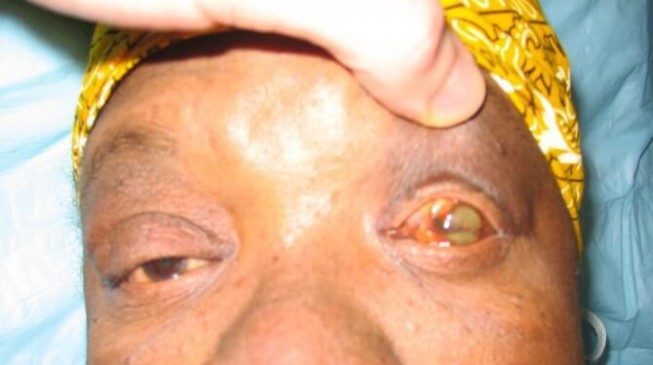 Nine killed as yellow fever spreads to 16 states