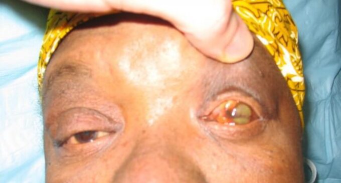 16 killed as yellow fever hits Ebonyi