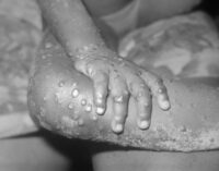 Two Nigerian travellers import monkeypox into UK