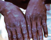 Delta confirms three cases of suspected monkeypox disease