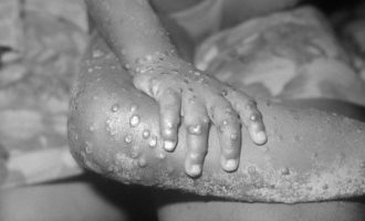 Patient ‘recovering’ from monkeypox commits suicide