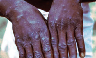 Delta confirms three cases of suspected monkeypox disease
