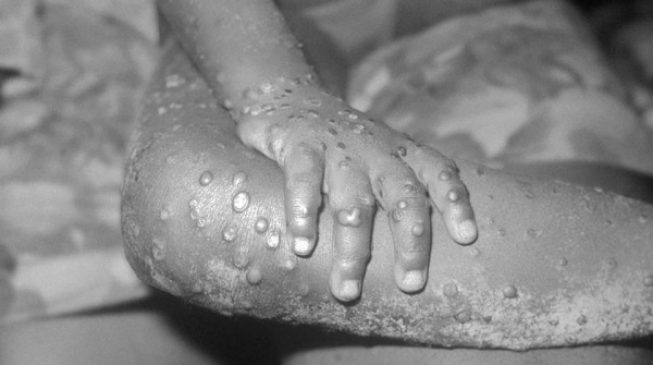 Two Nigerian travellers import monkeypox into UK