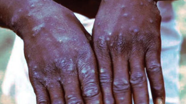 Delta confirms three cases of suspected monkeypox disease