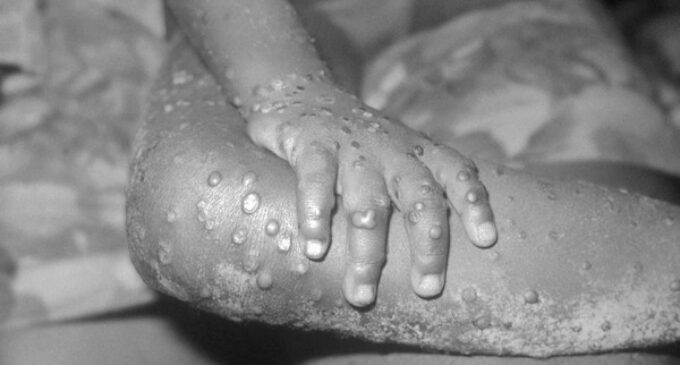 Patient ‘recovering’ from monkeypox commits suicide