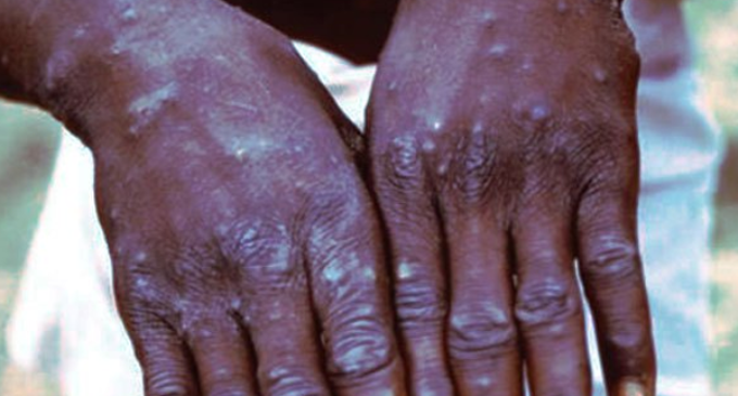 Lagos: We confirmed three cases of monkeypox in one month