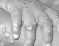 WHO: Monkeypox outbreak concentrated among men who have sex with men