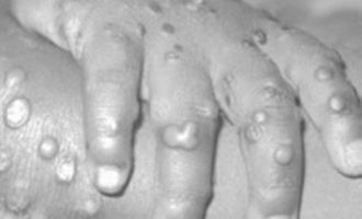 Forced monkeypox vaccination rumour baseless, says Bayelsa