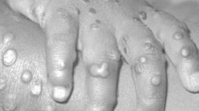 11 quarantined as ‘monkeypox hits Bayelsa’