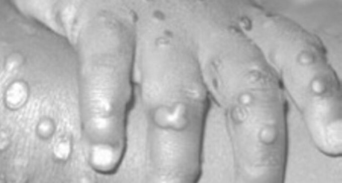 12 things to know about monkeypox