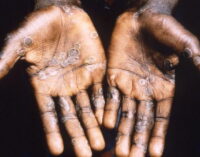 NCDC: 31 suspected cases of monkeypox reported in seven states