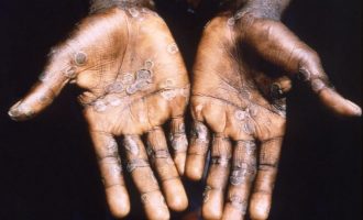 NCDC: 31 suspected cases of monkeypox reported in seven states