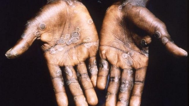 NCDC: 31 suspected cases of monkeypox reported in seven states