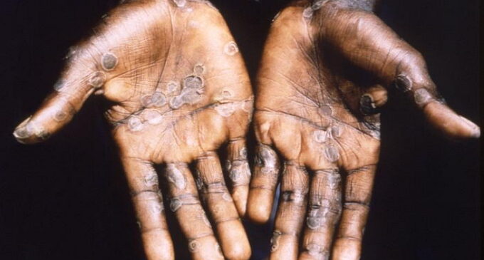 NCDC: 31 suspected cases of monkeypox reported in seven states