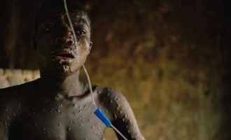 Panic in south-east as parents withdraw children from schools over monkeypox