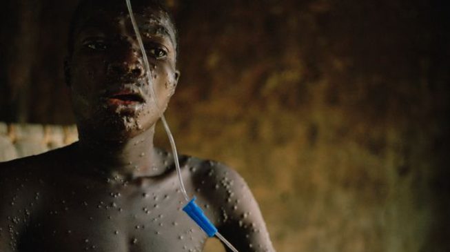 Panic in south-east as parents withdraw children from schools over monkeypox