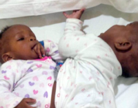 Conjoined Nigerian twins to live independently after Indian surgery