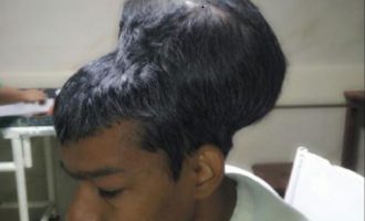 Surgeons successfully remove ‘world’s largest brain tumour’
