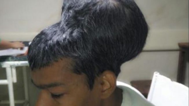 Surgeons successfully remove ‘world’s largest brain tumour’
