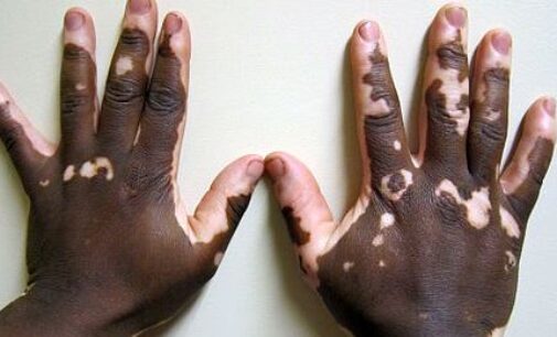 Scientists may have found the cure for vitiligo
