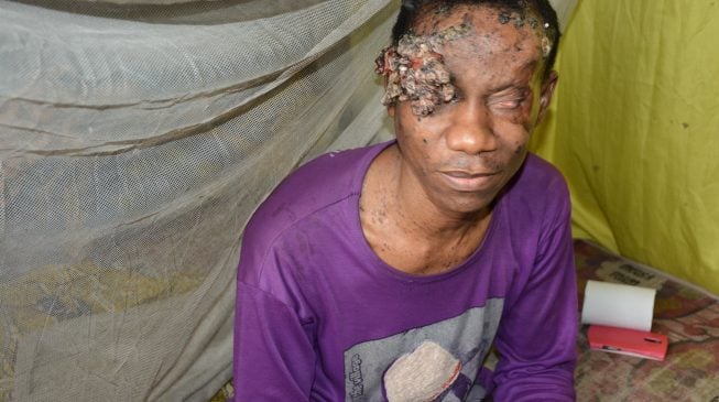 UNDERCOVER INVESTIGATION: Cancer is the disease, Nigeria’s health system is the killer