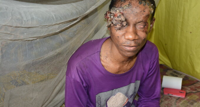 UNDERCOVER INVESTIGATION: Cancer is the disease, Nigeria’s health system is the killer