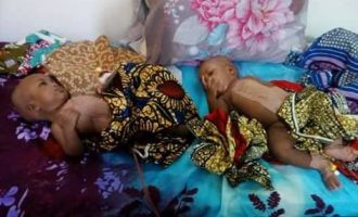 Doctors separate conjoined twins in Yola