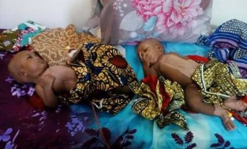 Doctors separate conjoined twins in Yola