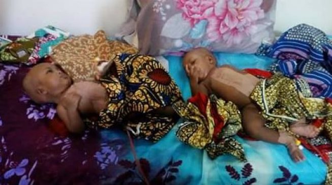 Doctors separate conjoined twins in Yola