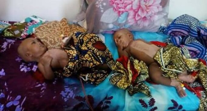 Doctors separate conjoined twins in Yola
