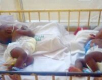 Doctors separate conjoined twins at UniAbuja hospital