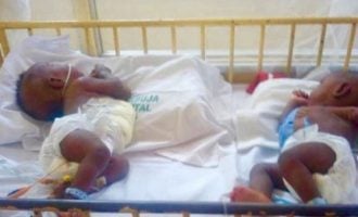 Doctors separate conjoined twins at UniAbuja hospital