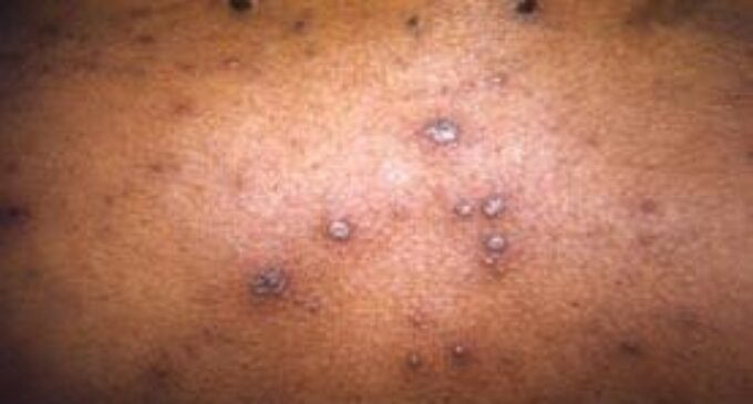 IMF/World Bank forum attendees asked to monitor symptoms as participant contracts chickenpox